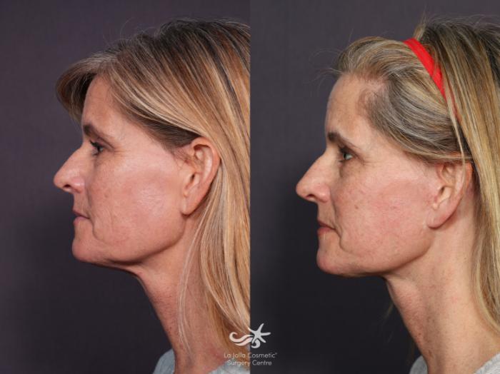 Facelift Before and After Pictures Result 818 | San Diego, CA | La