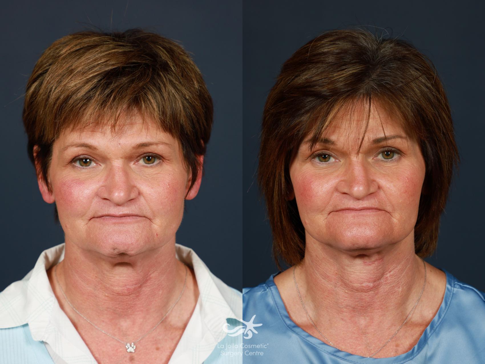 Before & After Facial Fat Transfer Result 1517 Front View in San Diego, CA