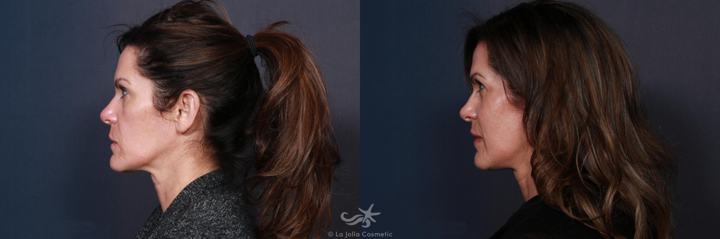Before & After Facial Fat Transfer Result 212 Left Side View in San Diego, CA