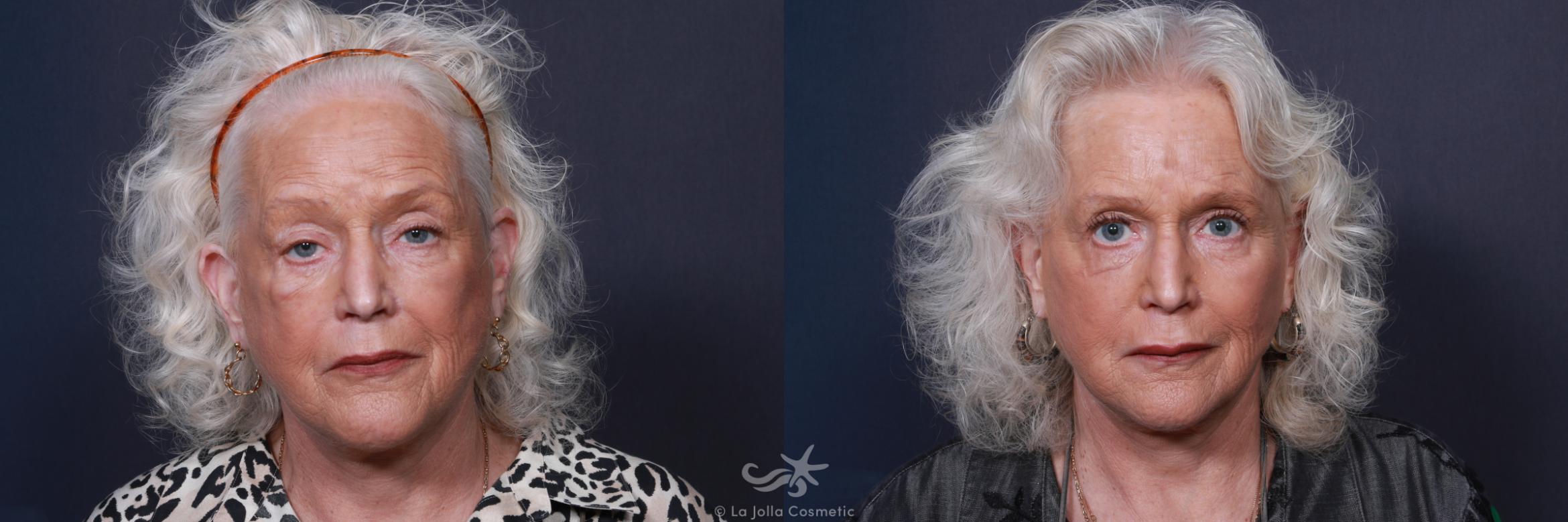 Before & After Facial Fat Transfer Result 319 Front View in San Diego, Carlsbad, CA