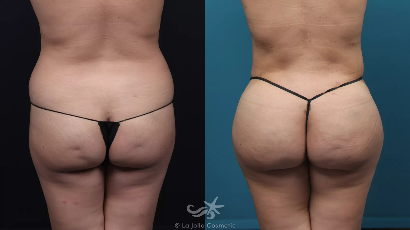Before & After Fat Transfer Body Result 41 Back View in San Diego, CA