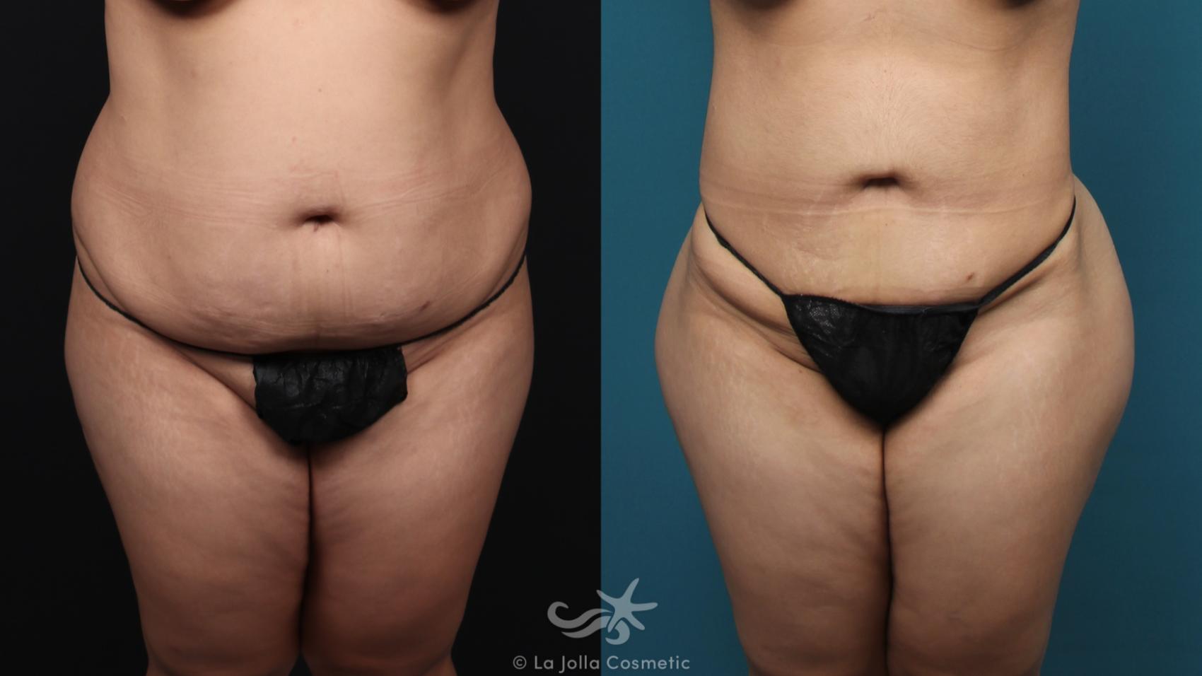 Before & After Fat Transfer Body Result 41 Front View in San Diego, CA