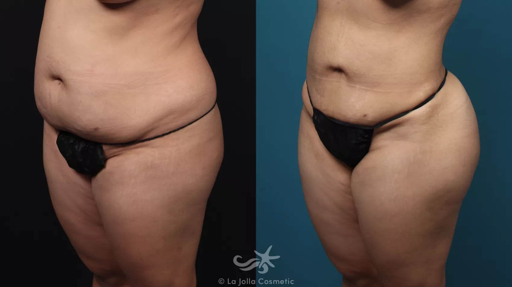 Before & After Fat Transfer Body Result 41 Left Oblique View in San Diego, CA