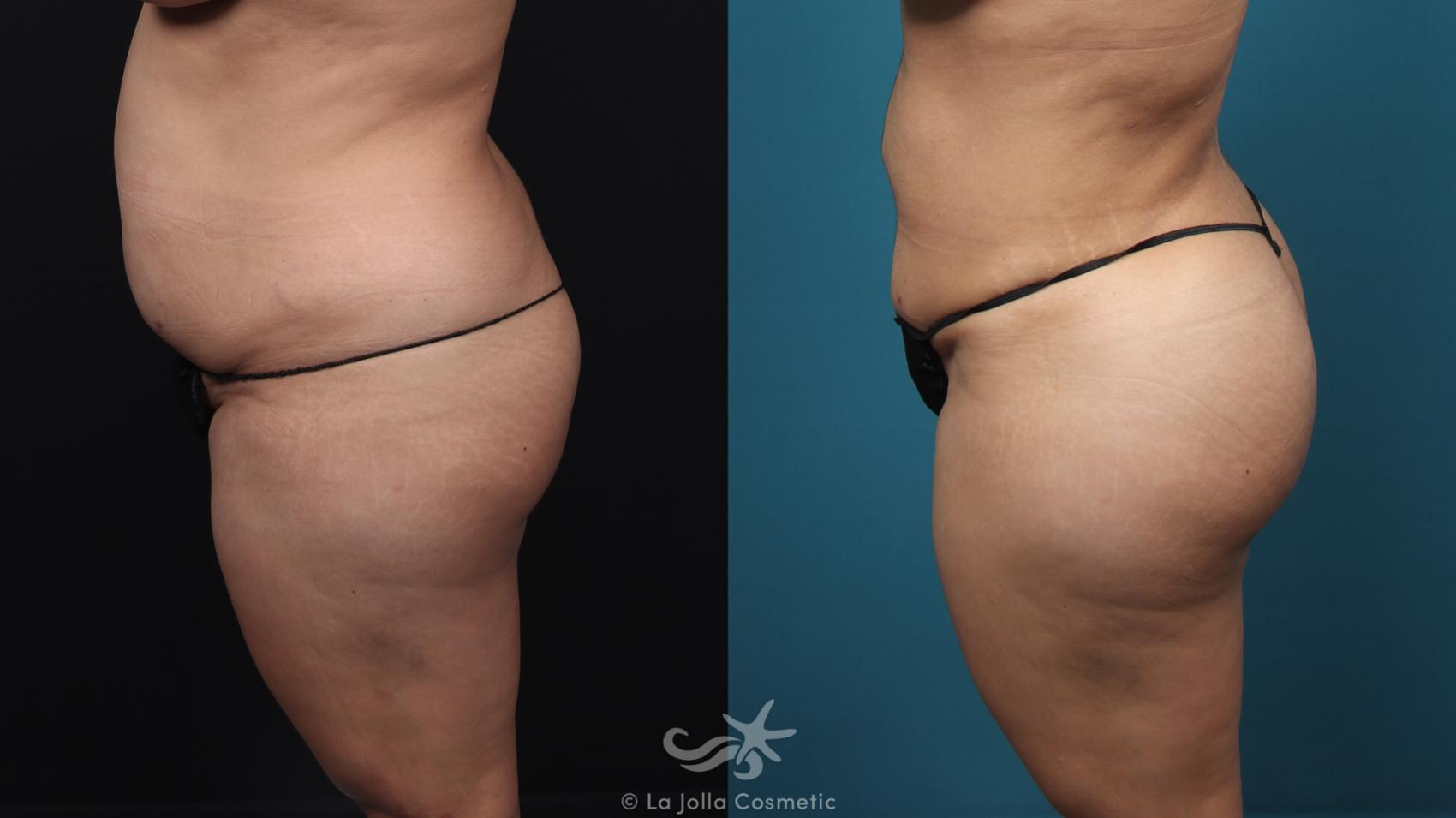 Before & After Fat Transfer Body Result 41 Left Side View in San Diego, CA