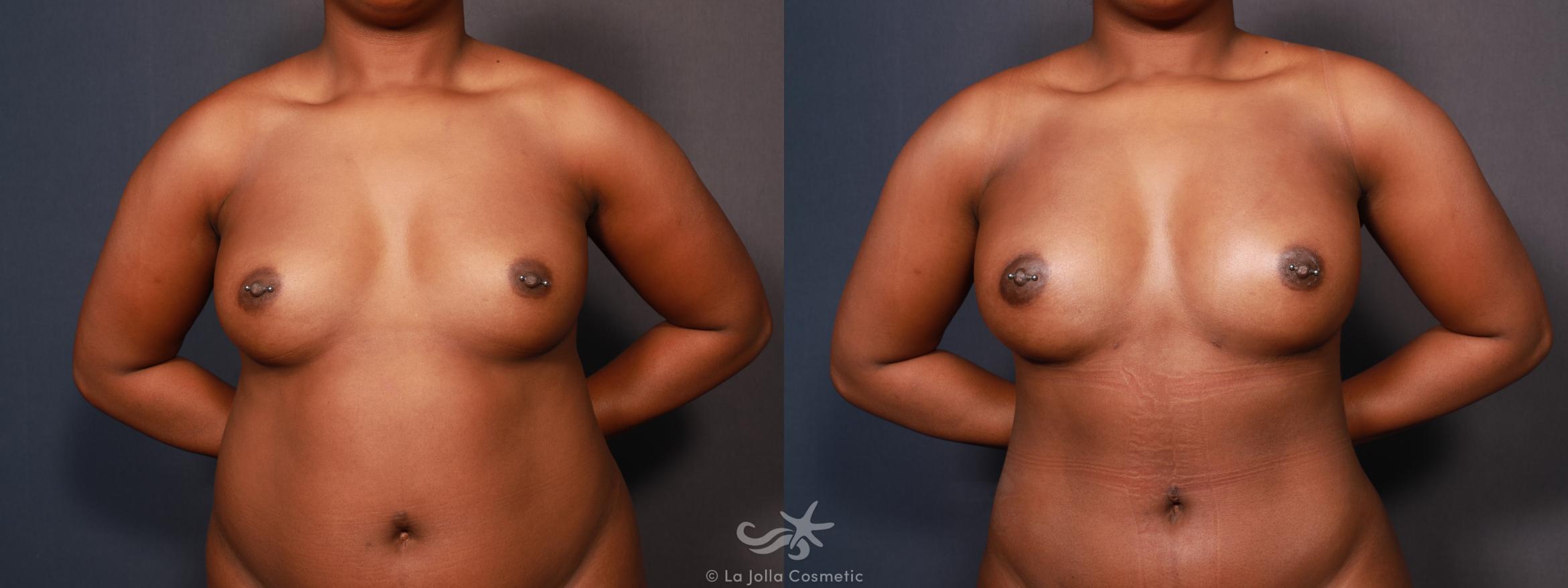 Before & After Fat Transfer Body Result 622 Front View in San Diego, CA