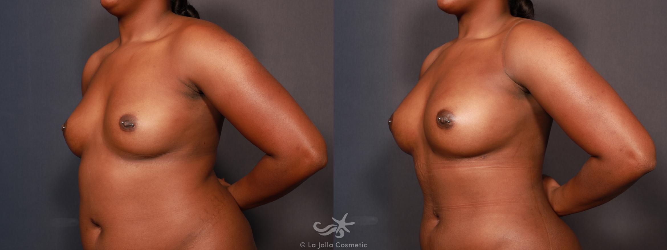 Before & After Fat Transfer Body Result 622 Left Oblique View in San Diego, CA