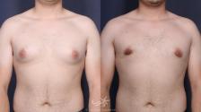 Before & After Gynecomastia Result 142 Front View in San Diego, Carlsbad, CA