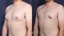 Before & After Gynecomastia Result 142 Left Oblique View in San Diego, Carlsbad, CA
