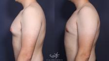 Before & After Gynecomastia Result 142 Left Side View in San Diego, Carlsbad, CA