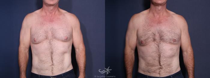 Before & After Gynecomastia Result 16 Front View in San Diego, Carlsbad, CA
