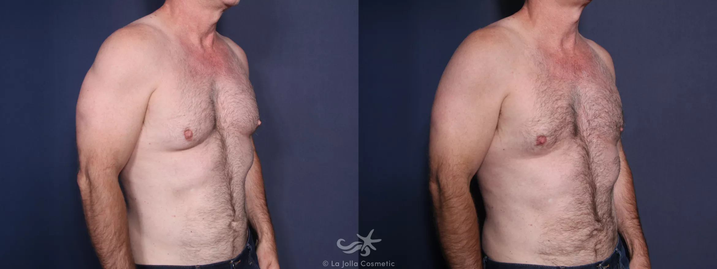 Before & After Gynecomastia Result 16 Right Oblique View in San Diego, CA