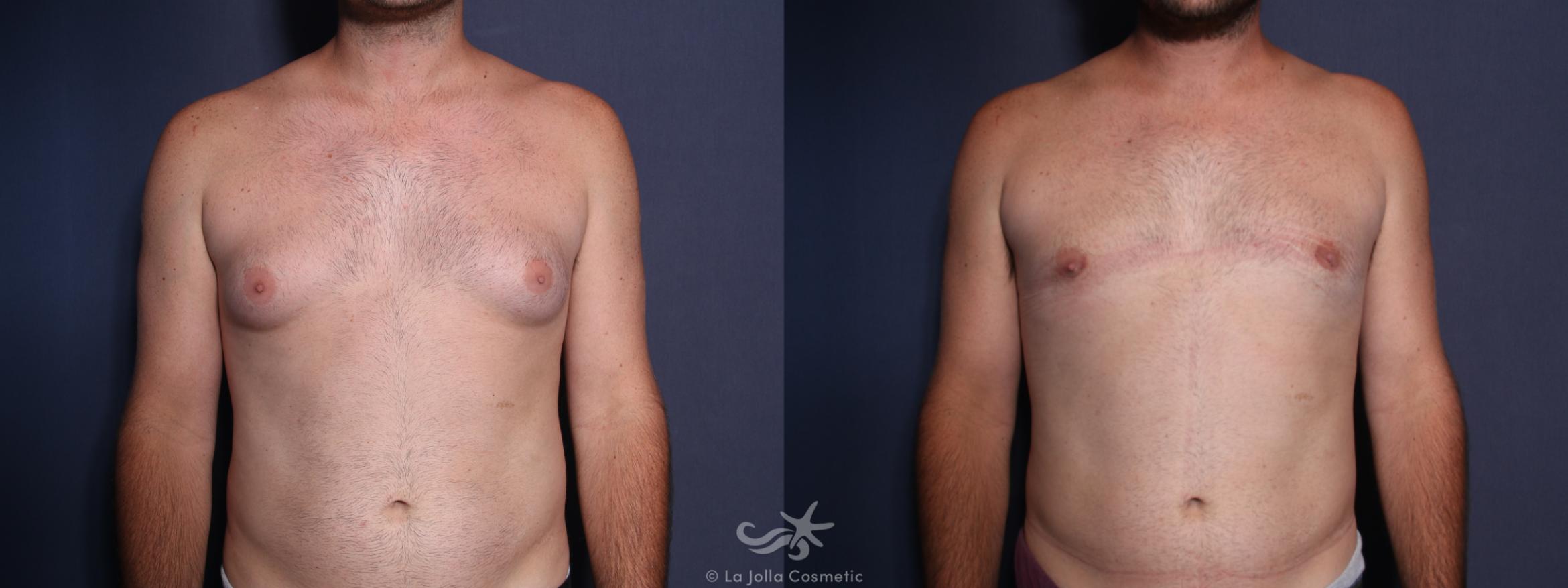 Before & After Gynecomastia Result 29 Front View in San Diego, Carlsbad, CA