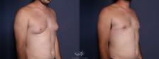 Before & After Gynecomastia Result 29 Right Oblique View in San Diego, Carlsbad, CA