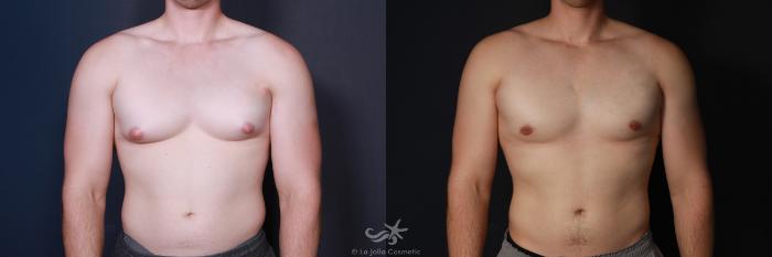 Before & After Gynecomastia Result 581 Front View in San Diego, Carlsbad, CA