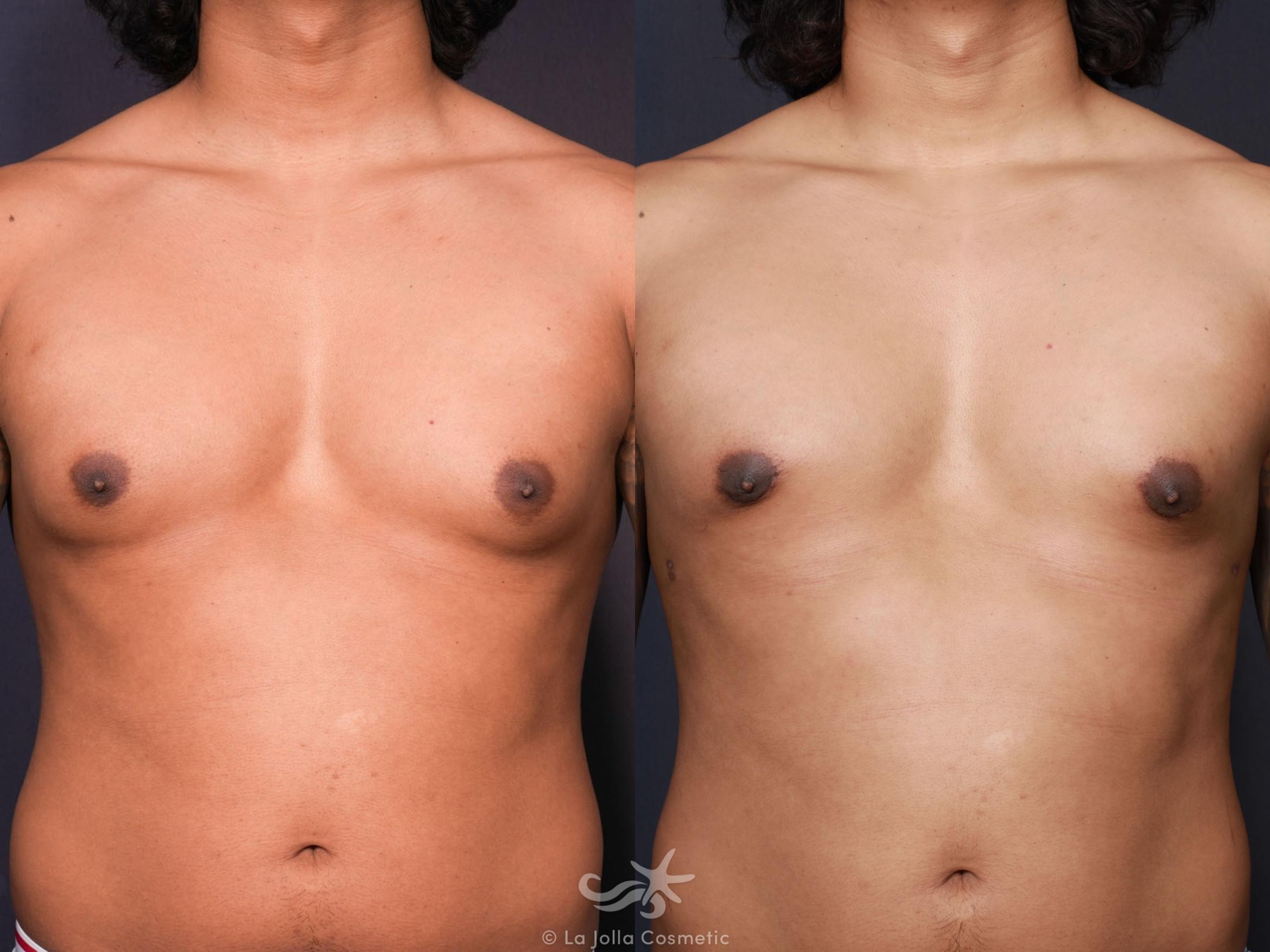 Before & After Gynecomastia Result 628 Front View in San Diego, CA