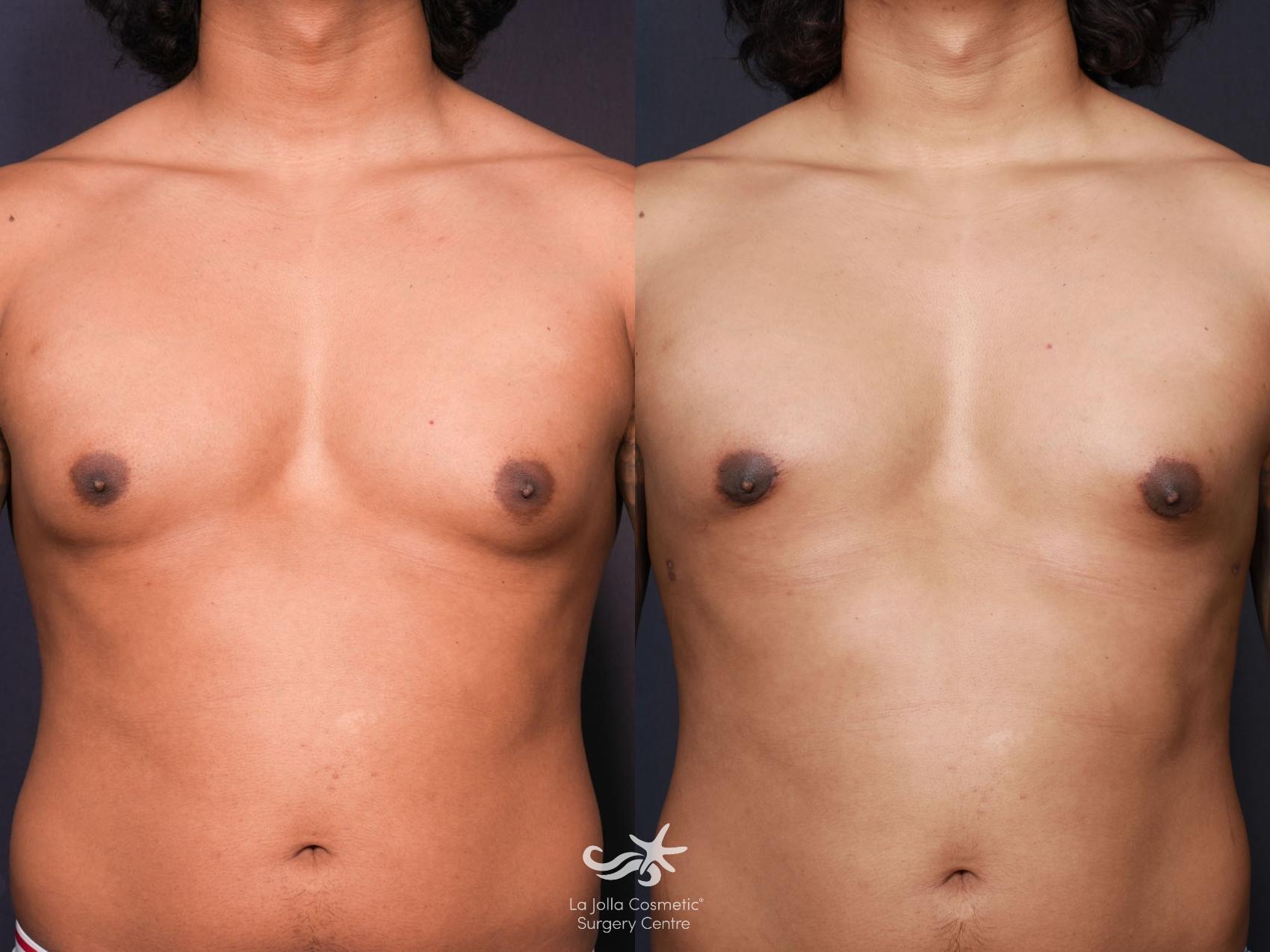 Gynecomastia Surgery Before and After Photos - ASPS