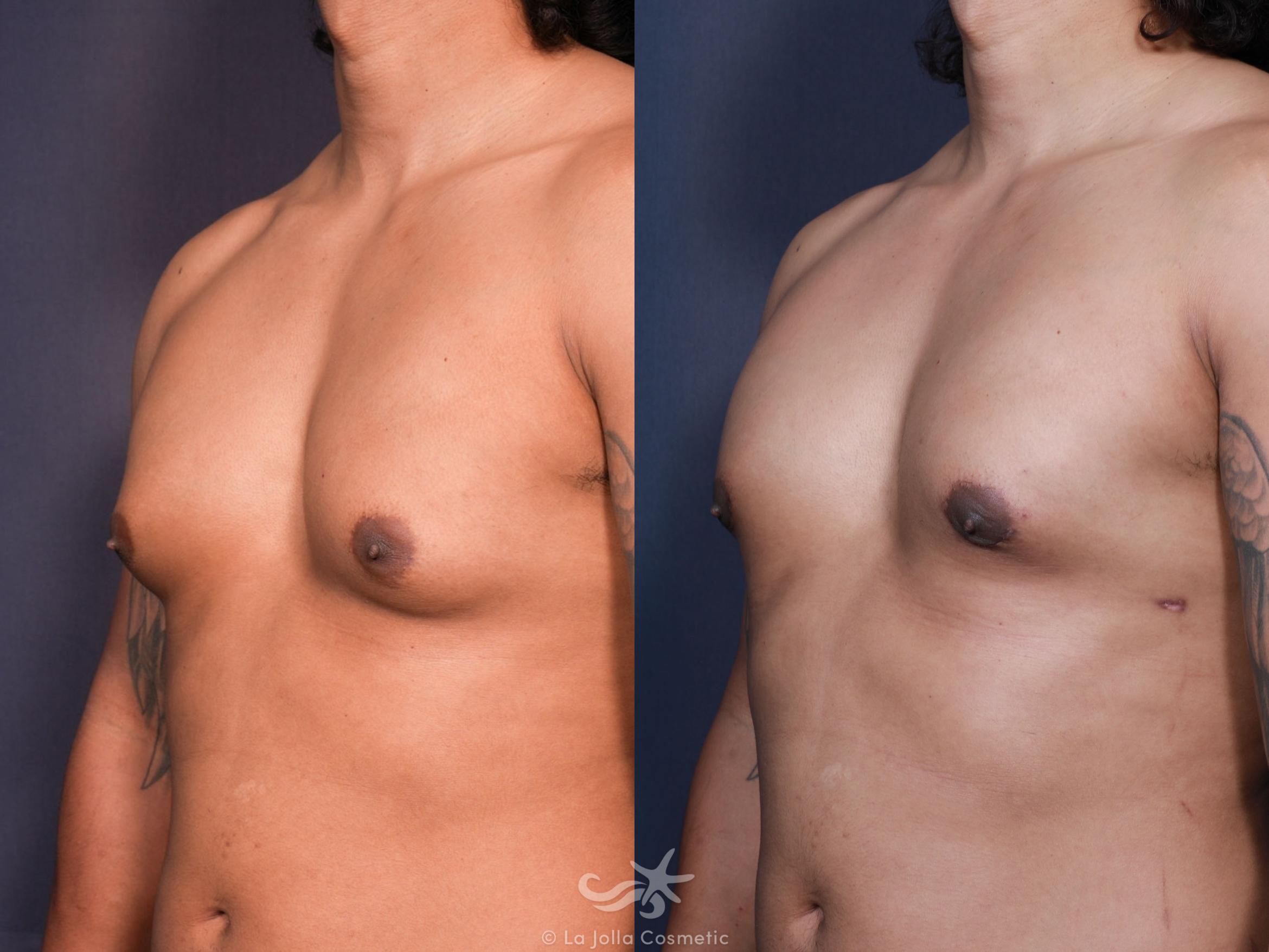 Before & After Gynecomastia Result 628 Left Oblique View in San Diego, CA