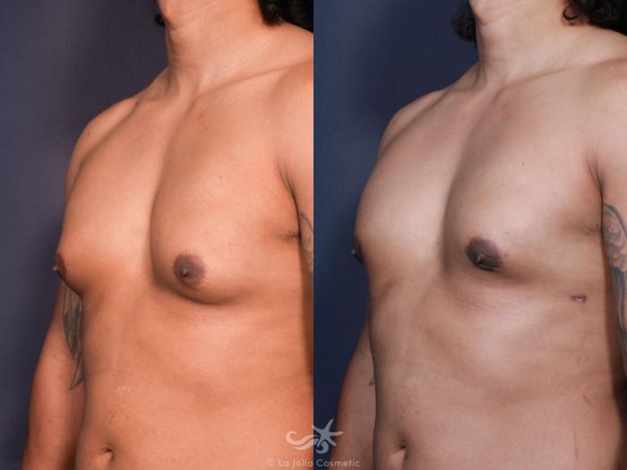 Before & After Gynecomastia Result 628 Left Oblique View in San Diego, Carlsbad, CA