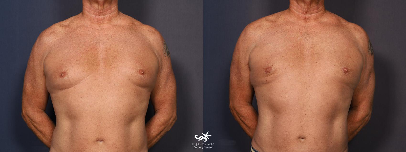 Understanding Gynecomastia and BMI for Men