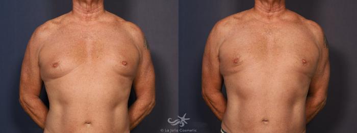 Before & After Gynecomastia Result 780 Front View in San Diego, Carlsbad, CA