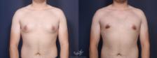 Before & After Gynecomastia Result 89 Front View in San Diego, Carlsbad, CA