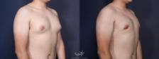 Before & After Gynecomastia Result 89 Right Oblique View in San Diego, Carlsbad, CA