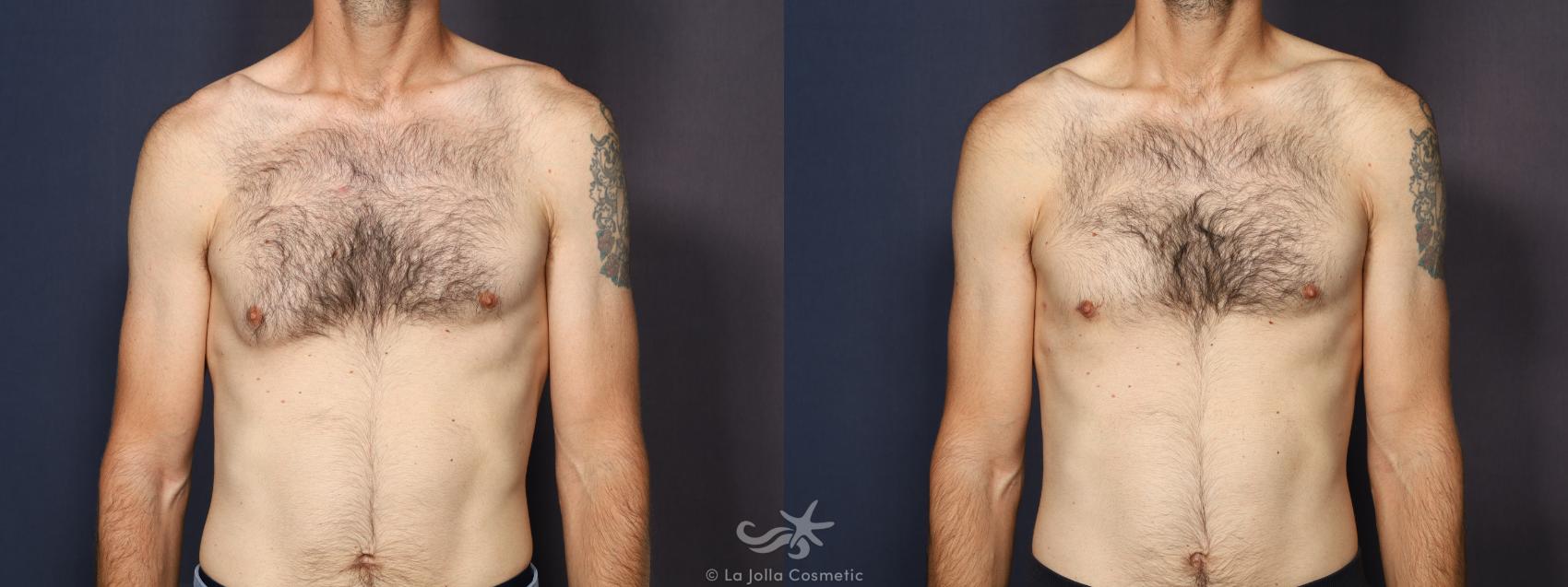Before & After Gynecomastia Result 964 Front View in San Diego, Carlsbad, CA