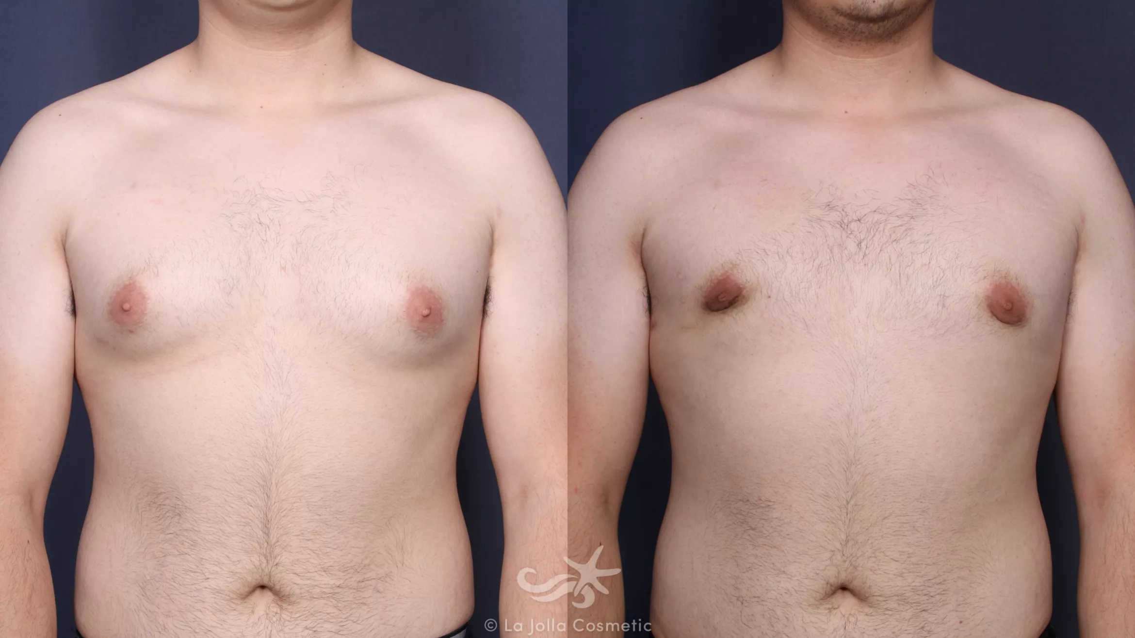 Before & After Gynecomastia Result 142 Front View in San Diego, CA
