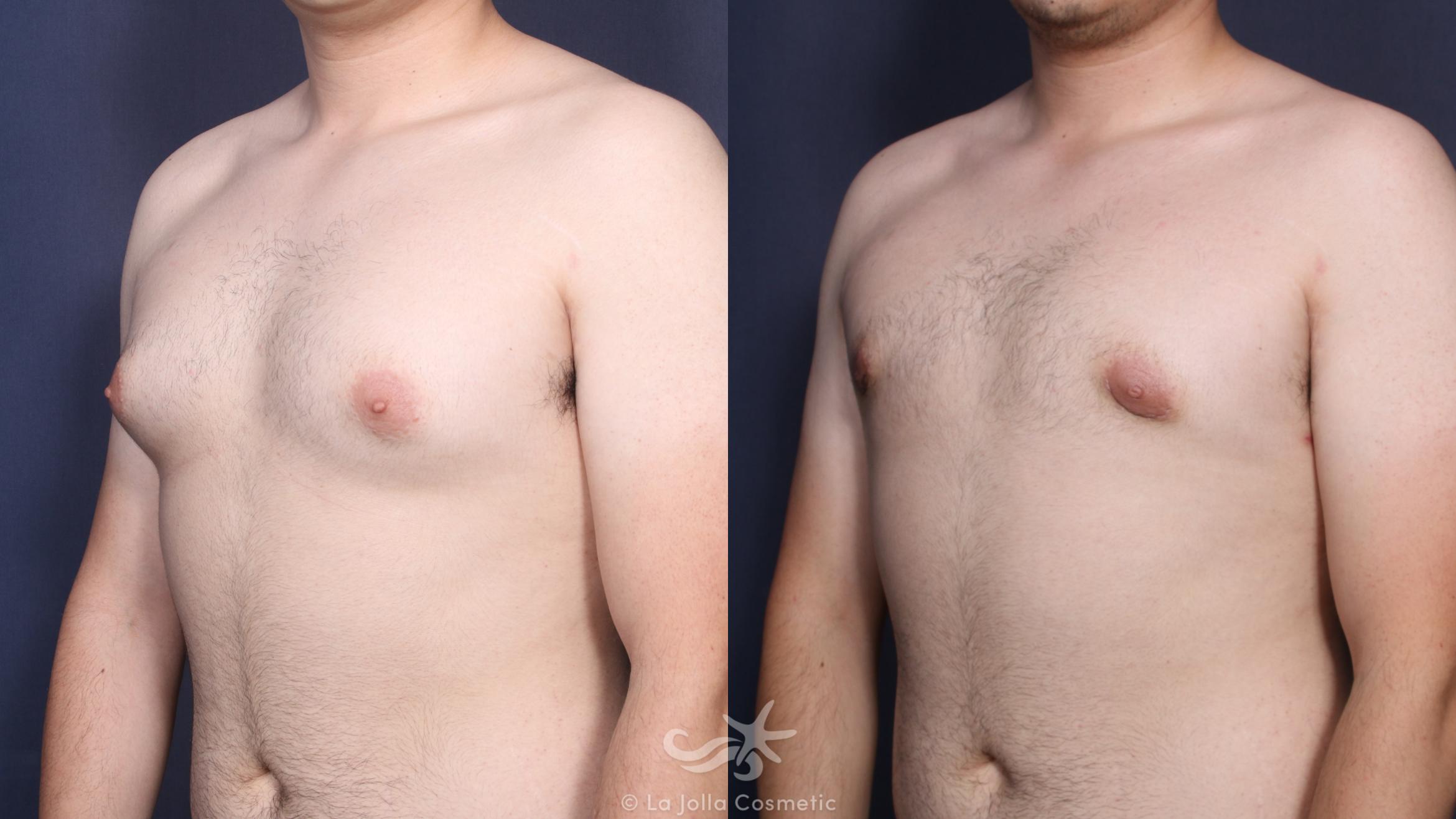 Before & After Gynecomastia Treatment Result 142 Left Oblique View in San Diego, CA