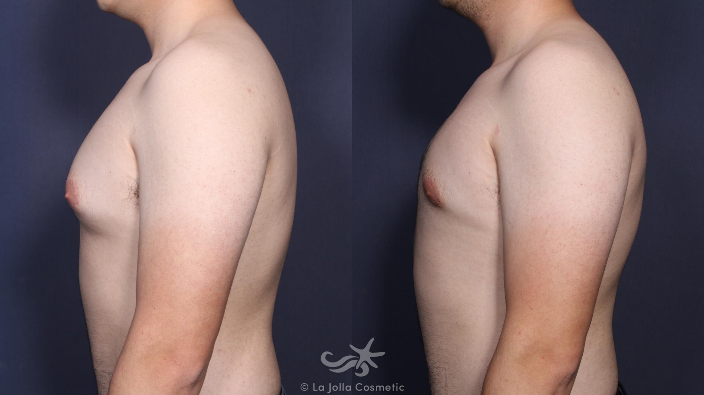 Before & After Gynecomastia Result 142 Left Side View in San Diego, CA