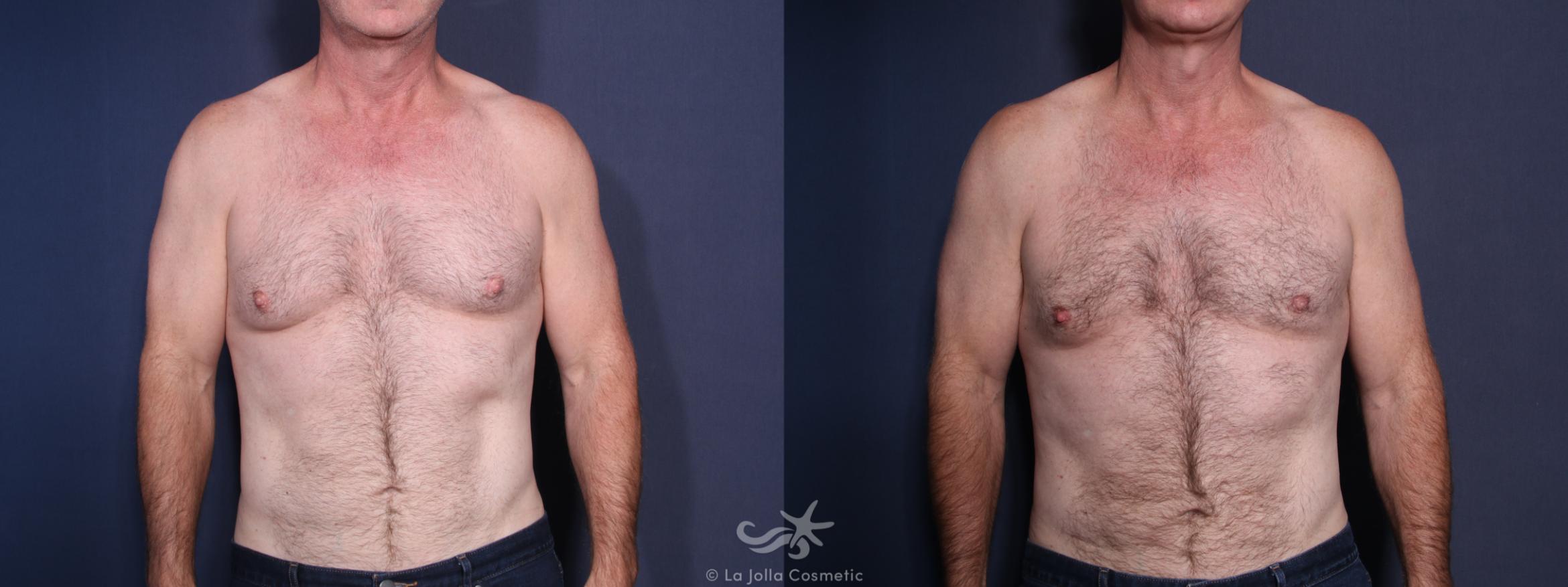 Before & After Gynecomastia Treatment Result 16 Front View in San Diego, CA