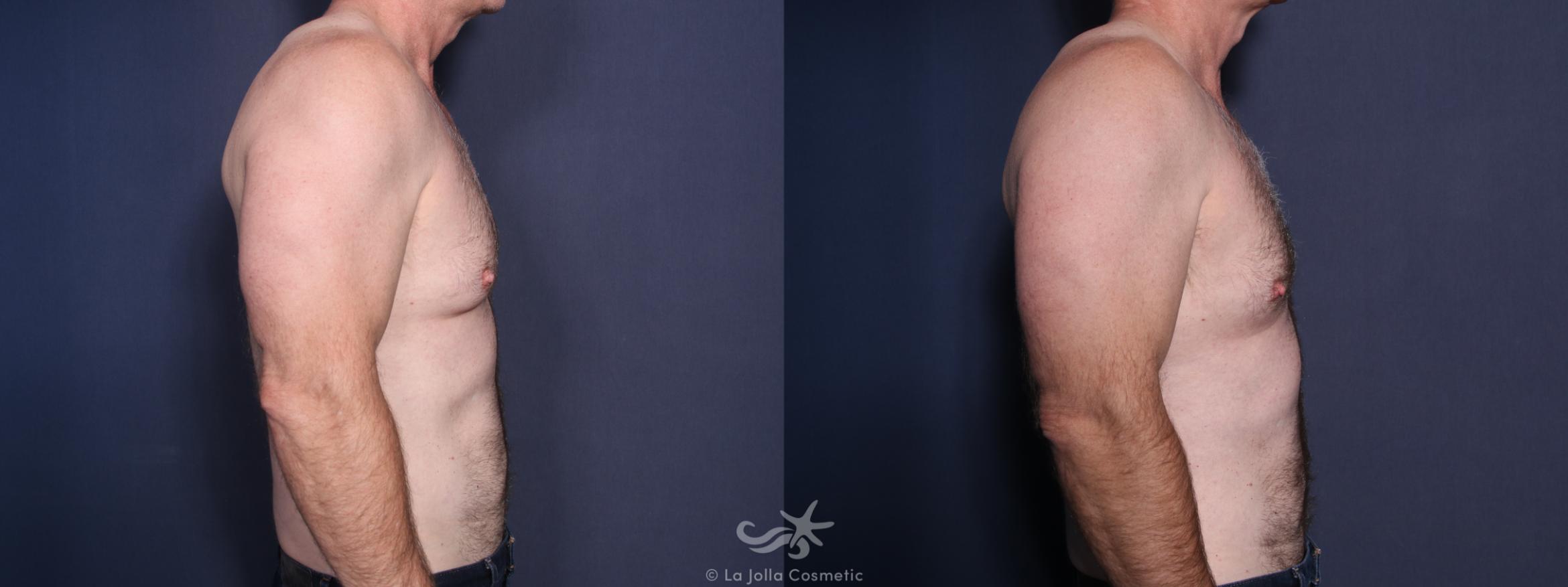 Before & After Gynecomastia Treatment Result 16 Right Side View in San Diego, CA