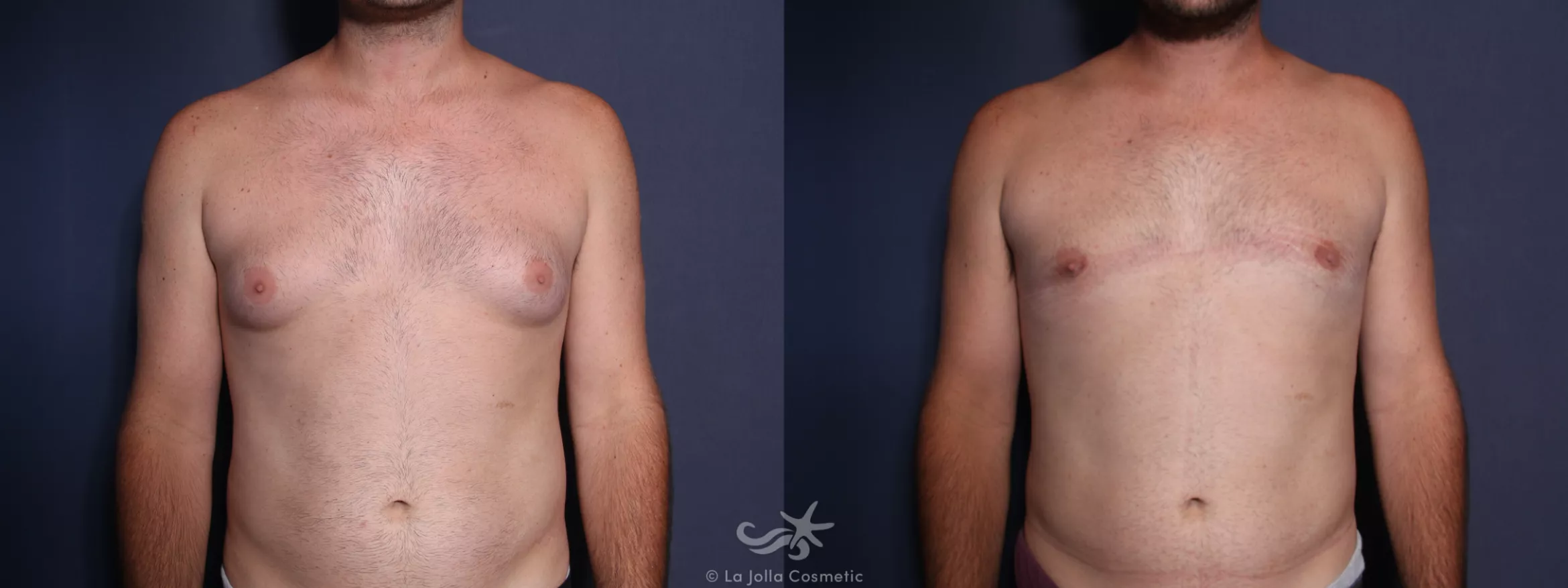 Before & After Gynecomastia Result 29 Front View in San Diego, CA