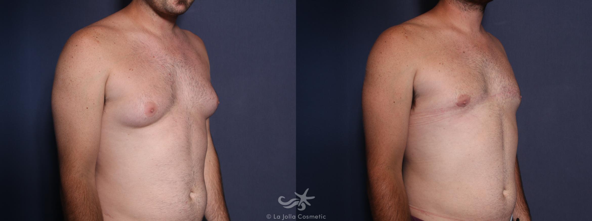 Before & After Gynecomastia Result 29 Right Oblique View in San Diego, CA