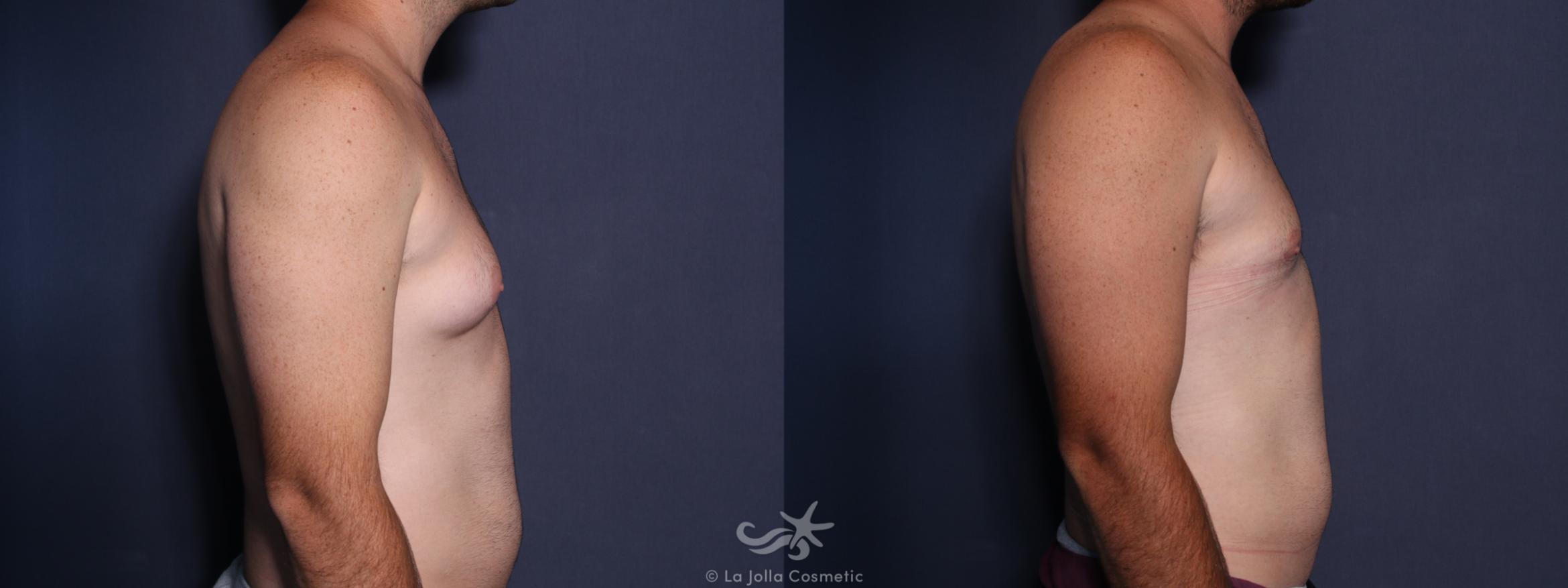 Before & After Gynecomastia Result 29 Right Side View in San Diego, CA