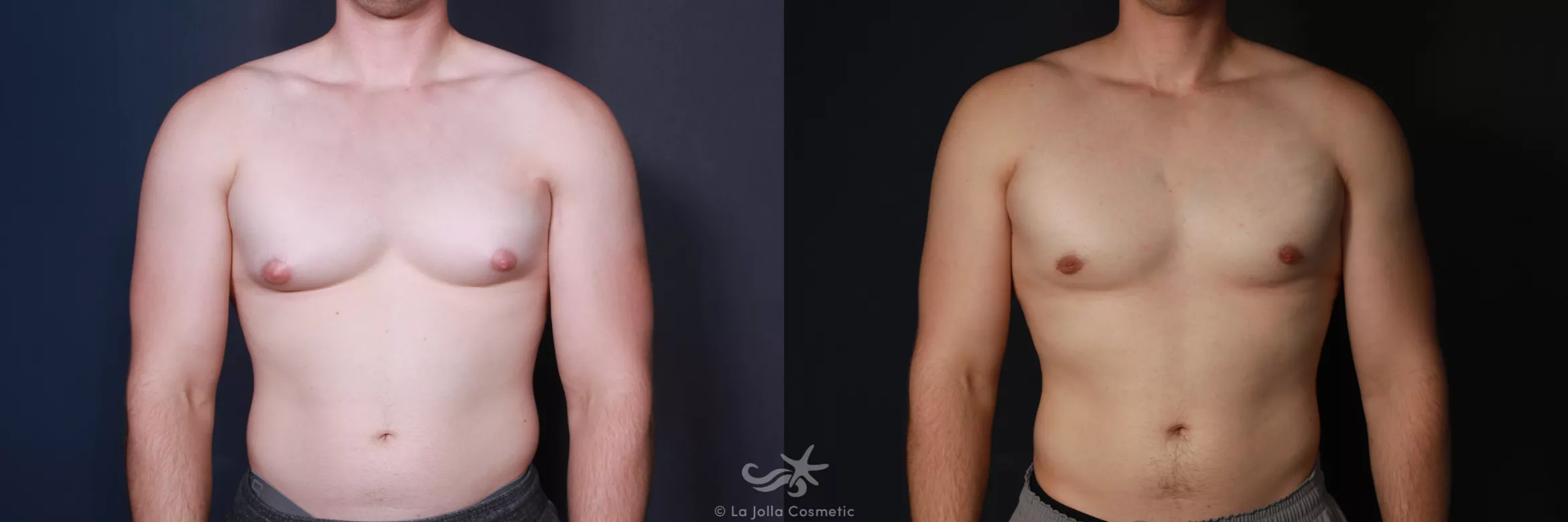 Before & After Gynecomastia Result 581 Front View in San Diego, CA