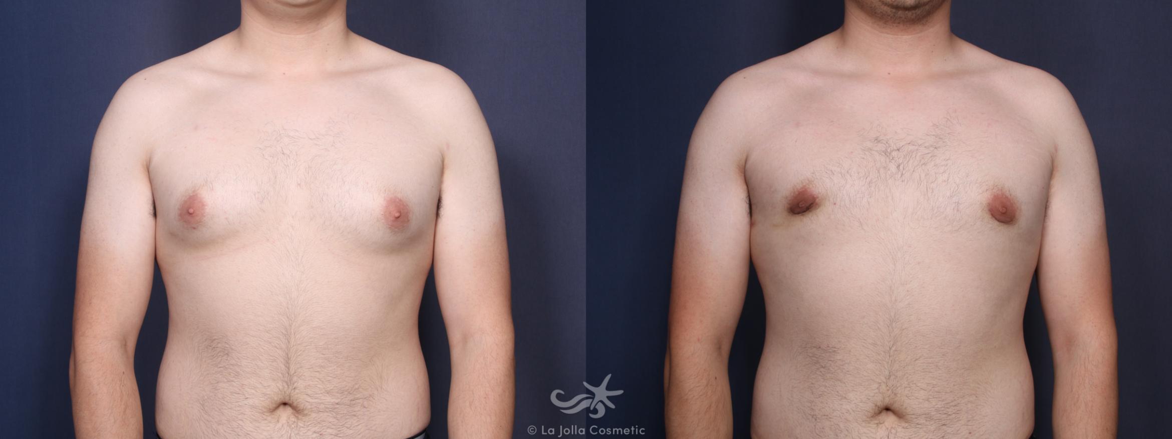 Before & After Gynecomastia Result 89 Front View in San Diego, CA