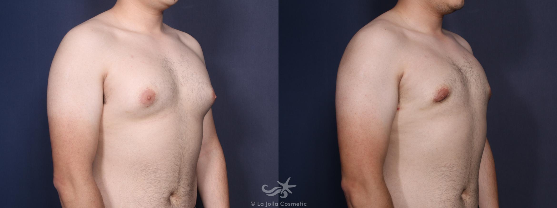 Before & After Gynecomastia Result 89 Right Oblique View in San Diego, CA