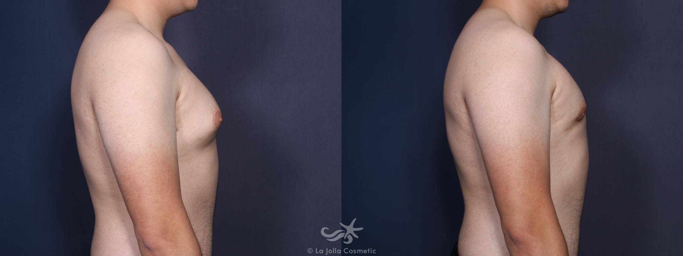 Before & After Gynecomastia Result 89 Right Side View in San Diego, CA