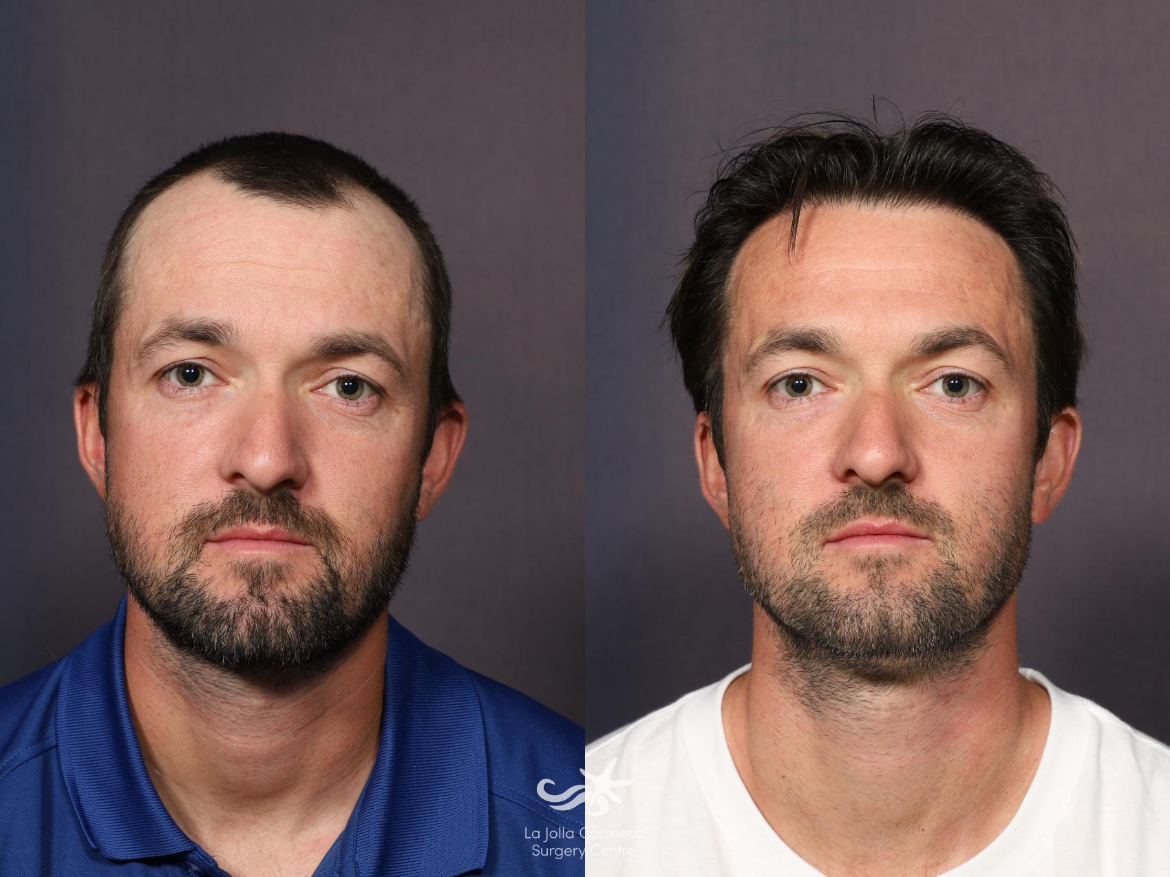 Before & After Hair Restoration Result 1115 Front View in San Diego, CA