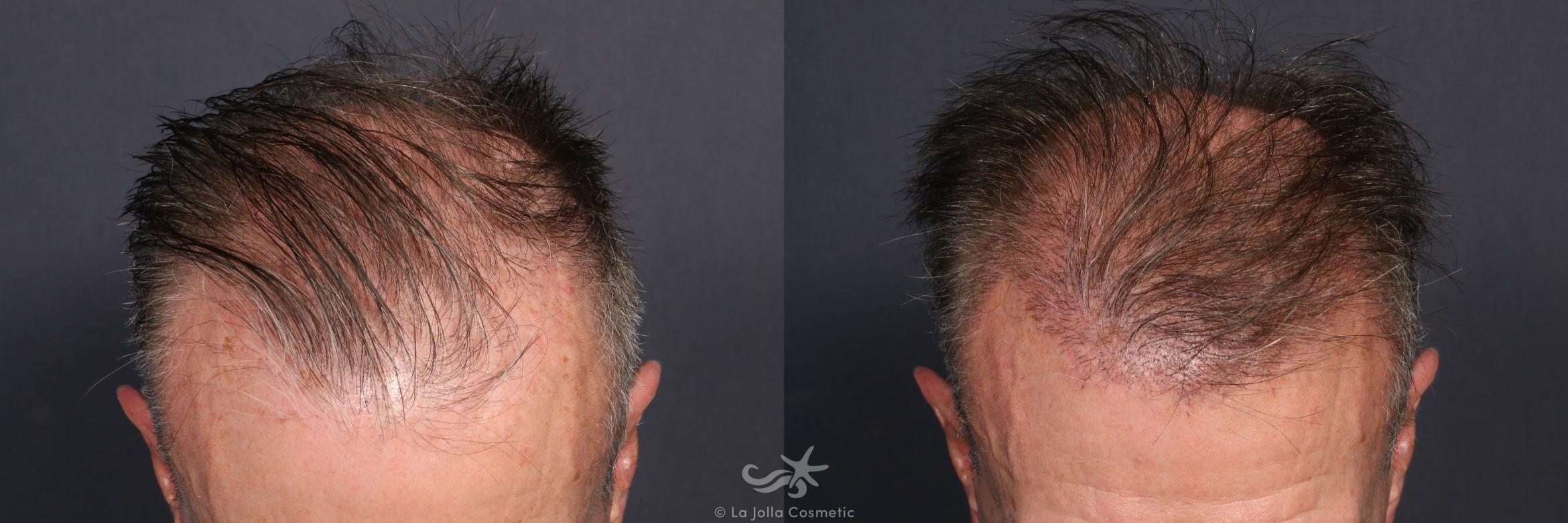 Before & After Hair Restoration Result 135 Above Head View in San Diego, CA