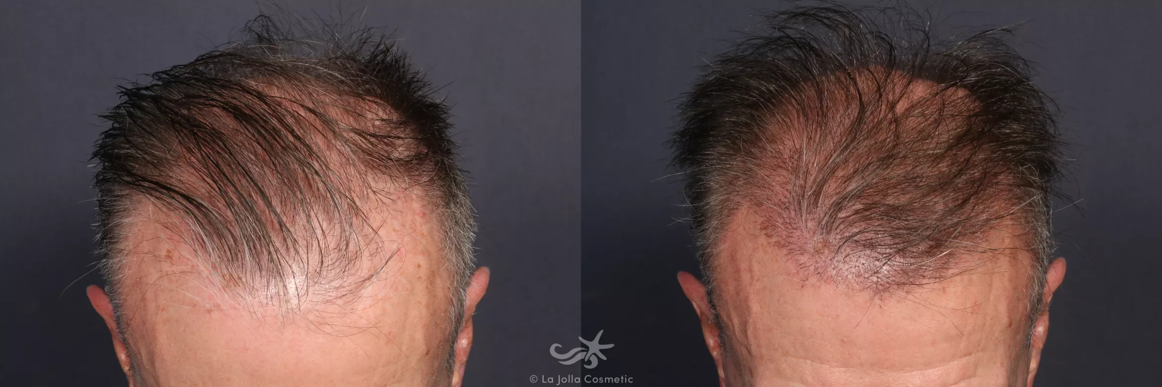 Before & After Hair Restoration Result 135 Above Head View in San Diego, CA