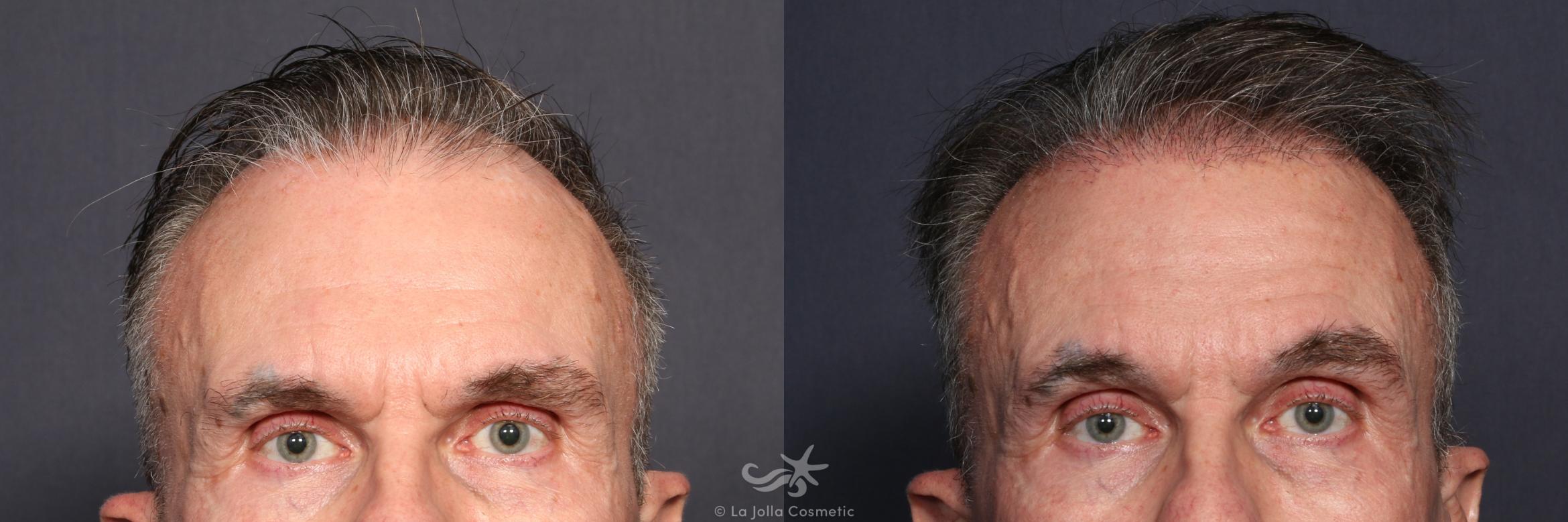 Before & After Hair Restoration Result 135 Front View in San Diego, Carlsbad, CA
