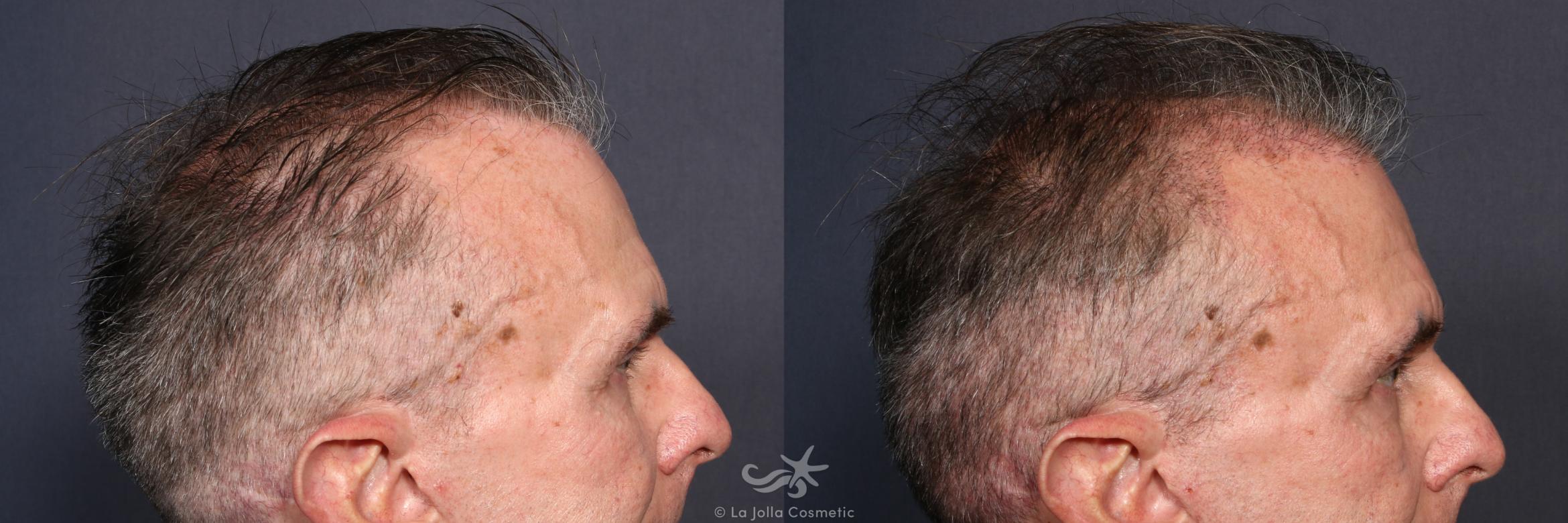 Before & After Hair Restoration Result 135 Right Side View in San Diego, CA