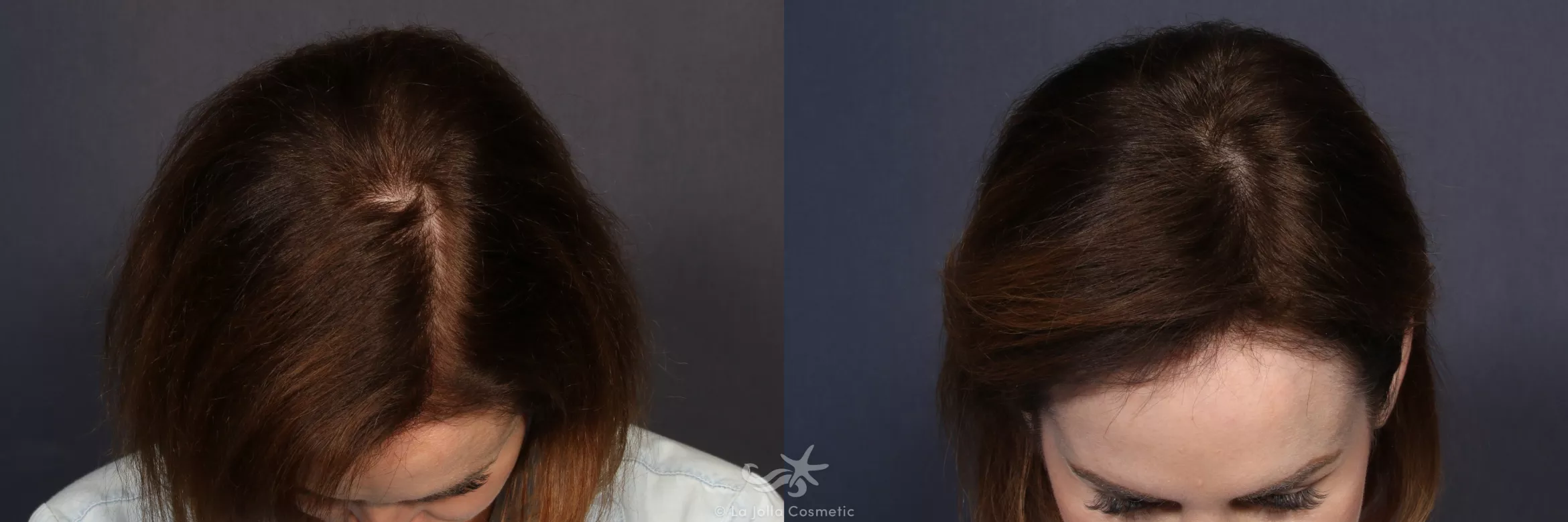 Before & After Hair Restoration Result 137 Above Head View in San Diego, CA