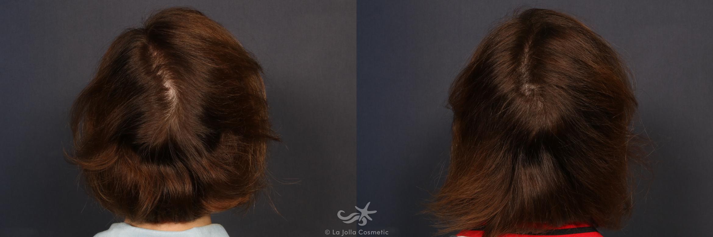 Before & After Hair Restoration Result 137 Back View in San Diego, CA