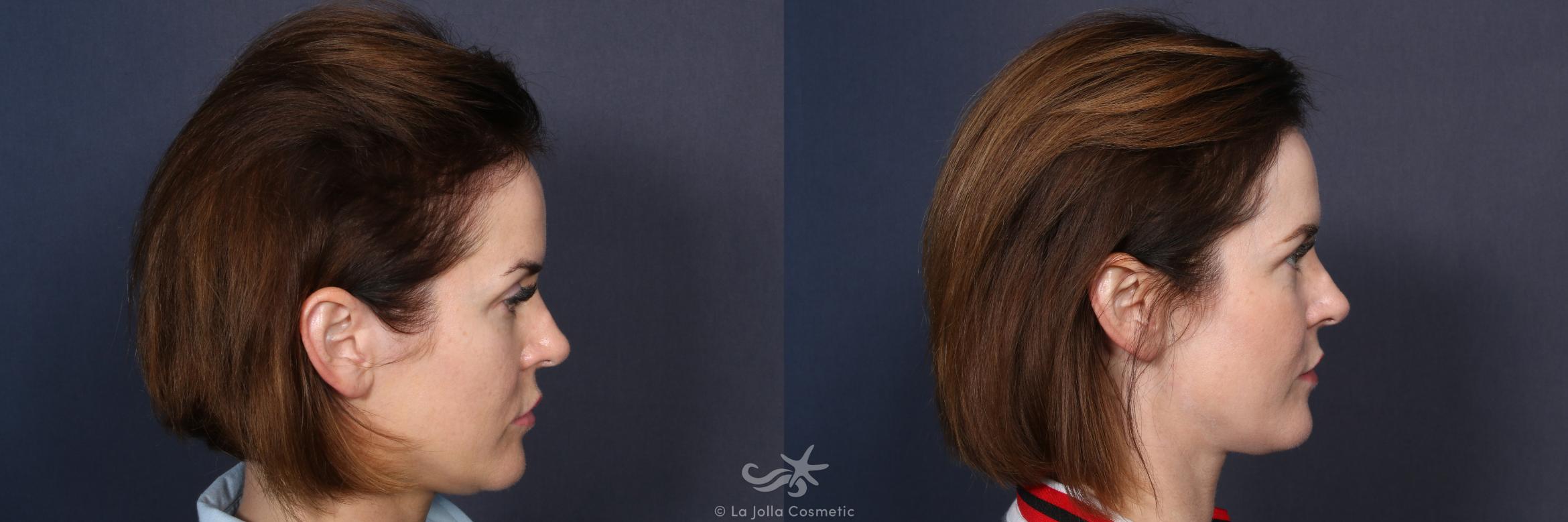 Before & After Hair Restoration Result 137 Right Side View in San Diego, CA