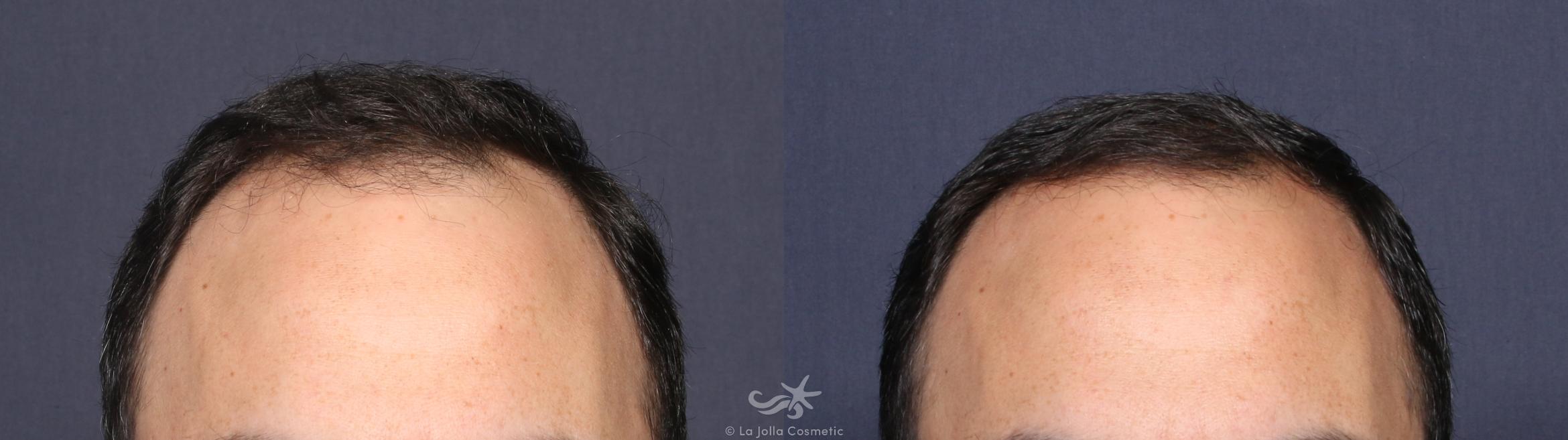 Before & After Hair Restoration Result 141 Front View in San Diego, CA