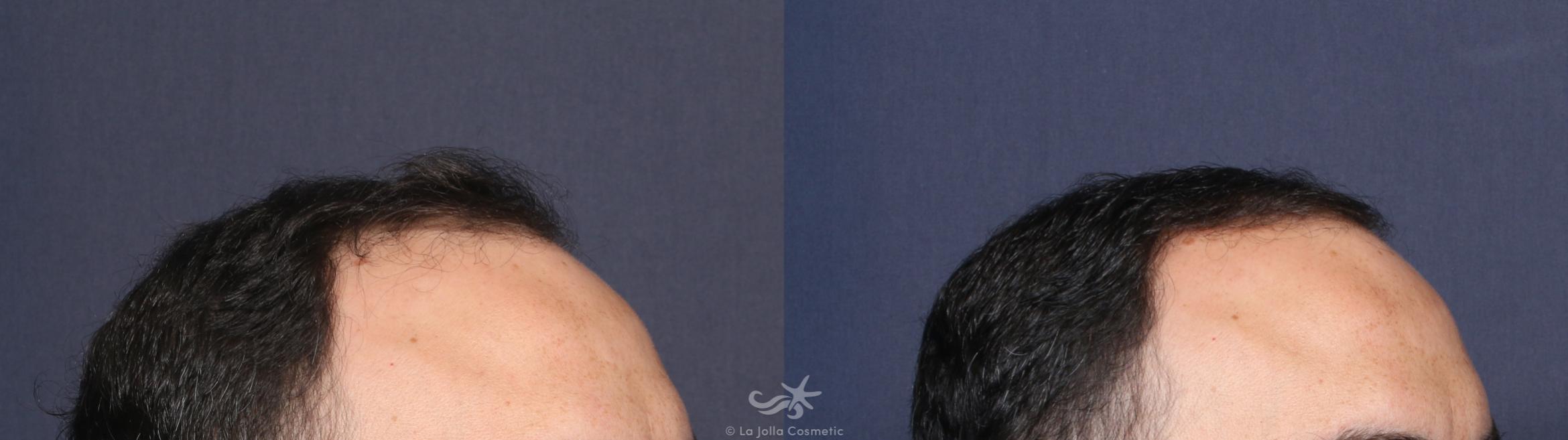 Before & After Hair Restoration Result 141 Right Oblique View in San Diego, CA