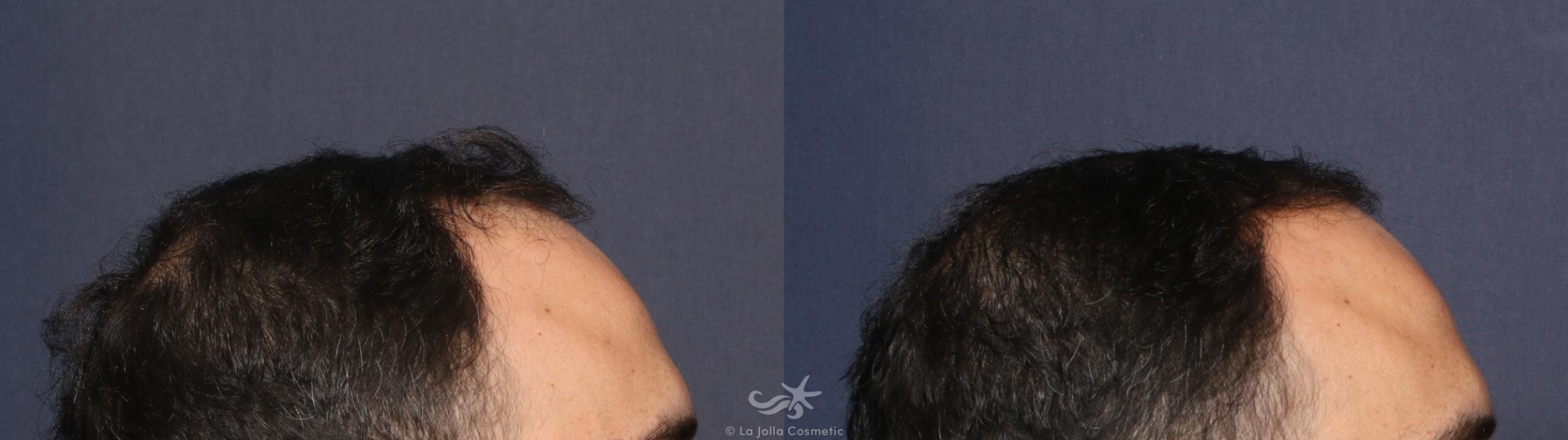 Before & After Hair Restoration Result 141 Right Side View in San Diego, CA